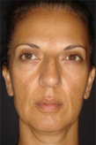 Patient # 84132 After Photo # 2